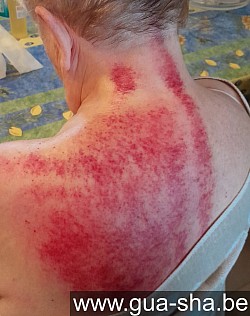 Massage Gua Sha à Bruxelles - Personne 81 ans