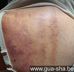 Massage Gua Sha - 24 heures plus tard - Personne 81 ans