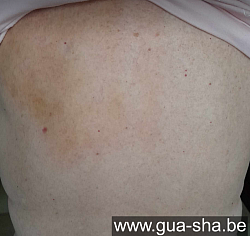 Massage Gua Sha au 4ième jour - Personne 81 ans