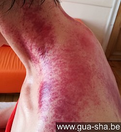 Traitement Massage Gua Sha Thaïlande Migraine & Acouphènes - Bruxelles