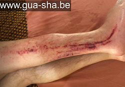 Traitement Massage Gua Sha Thaïlandais, uniquement de Cicatrices avec d'importantes adhérences et stases de sang- Bruxelles Belgique