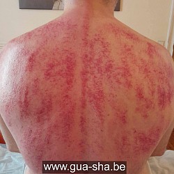 Traitement Massage Gua Sha Thaï Général - Bruxelles - Belgique