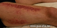 Traitement Partiel : Massage Gua Sha Thaï douleurs lombaires - Bruxelles