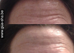 Massage thérapeutique thaï du visage Gua Sha / Amatarot - Formation workshop lifting naturel / gommage des rides du front à Bruxelles (possible en 1 seul traitement)